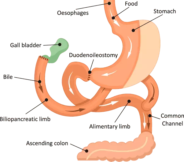 gastric-band-surgery