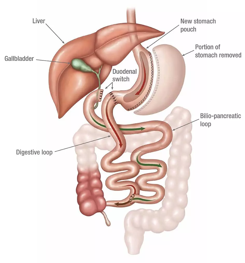 Gastric band surgery | The long term concerns