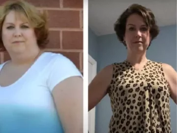 Weight-loss surgery: Woman discusses vertical sleeve gastrectomy