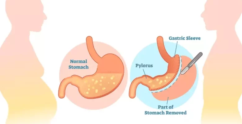 Gastric Sleeve Recovery Time: What to Expect?